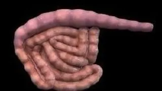 SINDROMUL DE INTESTIN IRITABIL (SII)