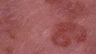 PSORIAZISUL