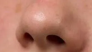 Lipsa simtului olfactiv, corelata cu lipsa durerii