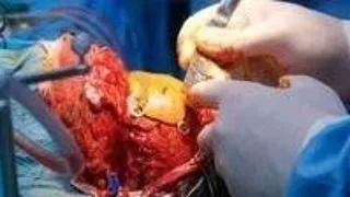 Craniectomia decompresiva poate avea consecinte nefaste pe termen lung