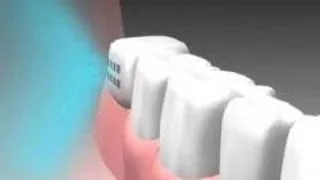 IMPLANTUL DENTAR CARE VINDECA