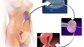 Cum decurge fertilizarea in vitro ? to?i pa?ii pe care trebuie s?-i urmezi