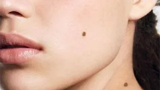 Cum iti dai seama daca o alunita este cancerigena. Semnele care trebuie sa te alarmeze!