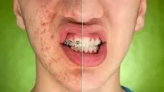 Acneea, cosmarul tuturor adolescentilor. Cum sa scapi de cosuri rapid si fara probleme. Nu te va costa aproape nimic