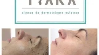 Cat de usor este sa indepartezi alunitele cu ajutorul laserului?