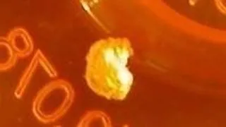 LITIAZA RENALA SAU PIETRELE LA RINICHI