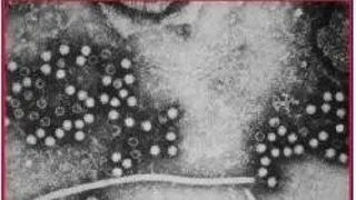 HEPATITA VIRALA E