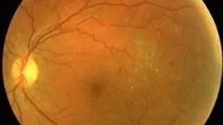 RETINOPATIA DIABETICA